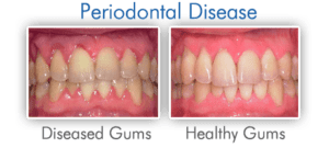 Gum Disease Gum-Disease