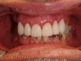cosmetic compare 2 after dentist in regina best cosmetic dental treatment