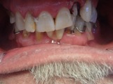 cosmetic compare 2 before cosmetic dentistry downtown regina dentist